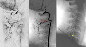 Особенности гипоплазии позвоночных артерий (правой и левой)