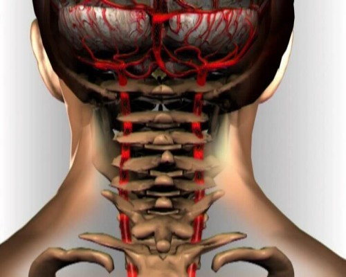 Гипоплазия левой позвоночной артерии – чем это грозит?