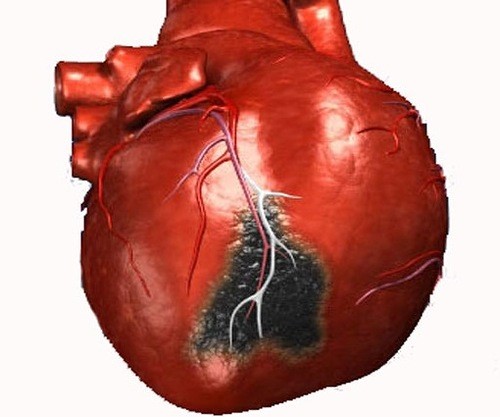 Как проявляются симптомы разных форм и видов инфаркта миокарда?