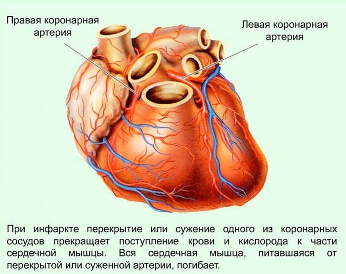 Что провоцирует возникновение инфаркта?