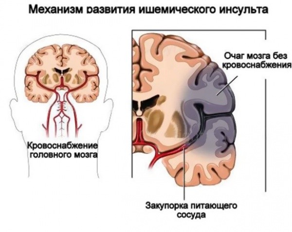 Причины инсульта головного мозга