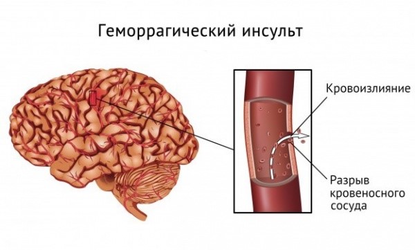 Причины инсульта головного мозга