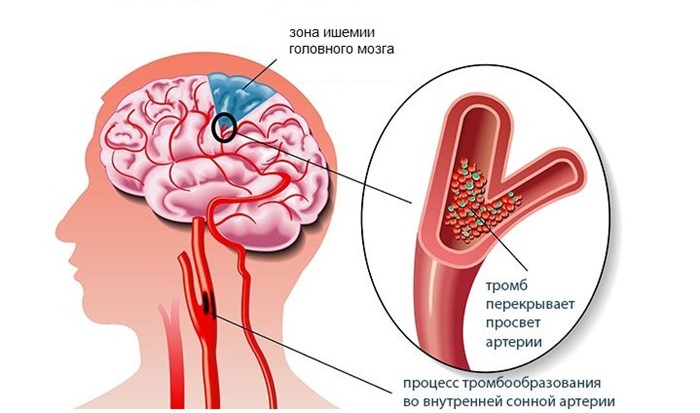 Ишемическая болезнь головного мозга: почему возникает, эффект от лечения