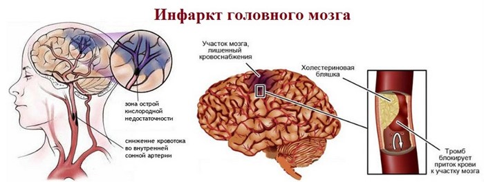 Ишемическая болезнь головного мозга: почему возникает, эффект от лечения