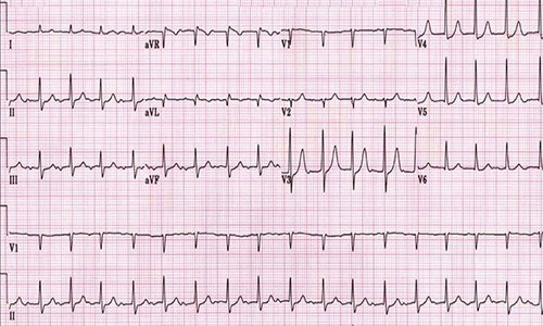 Проведение электрокардиограммы - быстрый способ выявления заболеваний сердца