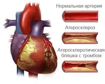 От чего зависит продолжительность жизни после стентирования сердца?
