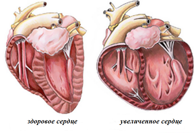 Кардиомегалия (увеличение сердца): причины, лечение