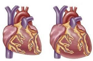 Что такое кардиопатия у взрослых?