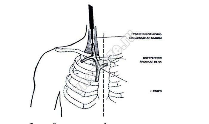 Катетеризация вен и артерий