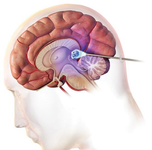 Киста головного мозга: виды, симптомы и лечение