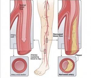 Облитерирующий атеросклероз нижних конечностей (ног)
