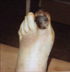 Облитерирующий атеросклероз нижних конечностей (ног)