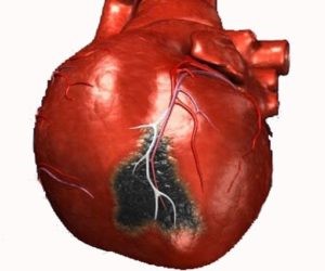 Особенности выполнения коронарного шунтирования сердца