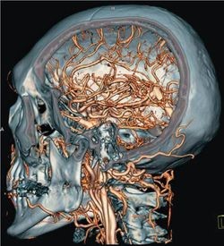 Что такое ангиография сосудов головного мозга?