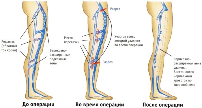 Операции по удалению вен на ногах