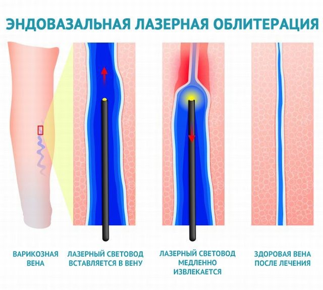 Операции по удалению вен на ногах