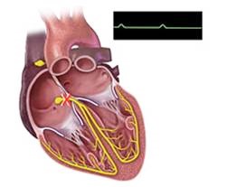 Что такое кардиостимулятор и какие ограничения после его установки?