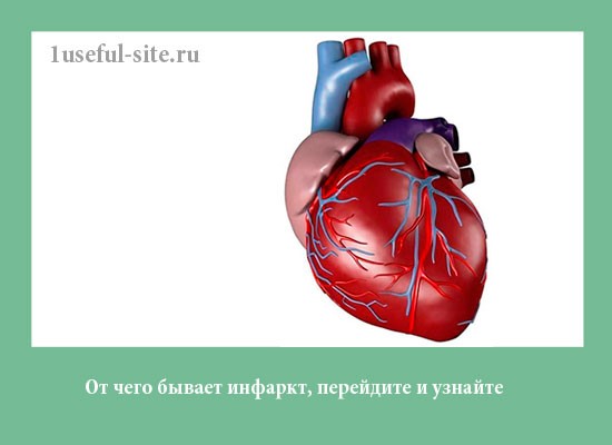 Основные причины обширного инфаркта миокарда