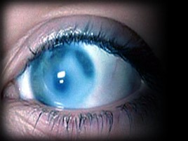 От чего лопаются капилляры в глазах?