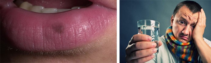 Цианоз, акроцианоз, синюшность: губ, кожи, носогубного треугольника