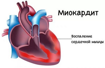 Особенности постмиокардического кардиосклероза