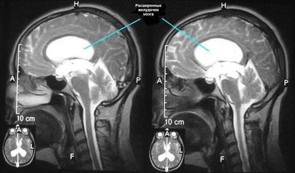 Шунтирование сосудов головного мозга: операция, последствия