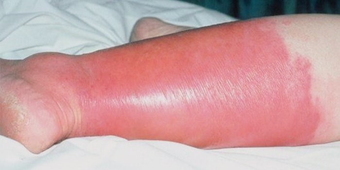 Особенности тромбофлебита поверхностных вен на ногах