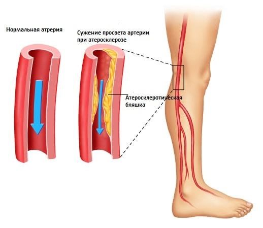 Окклюзия артерий ног и ее лечение