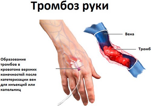 Факторы возникновения тромбоза сосудов рук, его симптоматика и терапия