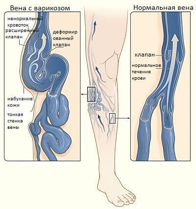 УЗИ-диагностика заболеваний сосудов ног