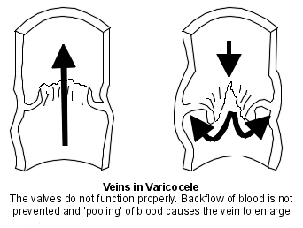 Симптомы и причины появления варикоцеле