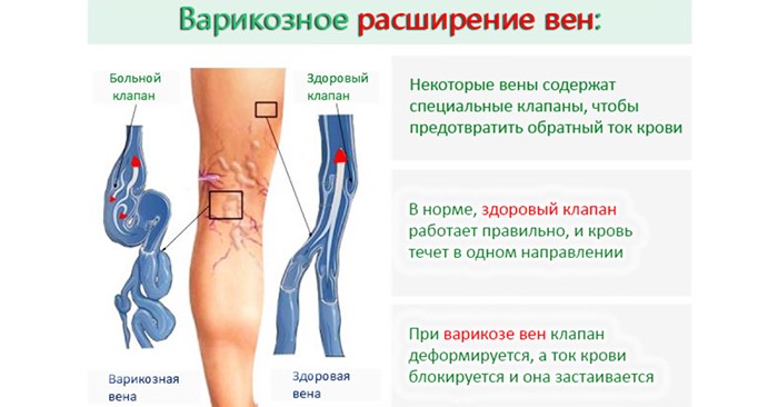 Профилактика варикозного расширения вен на ногах