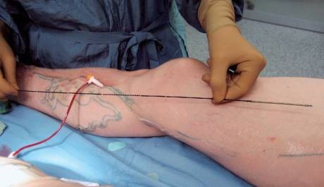 Оперативное лечение варикозного расширения вен на ногах