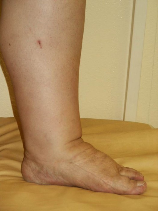 Венозная недостаточность ног: ретикулярный варикоз