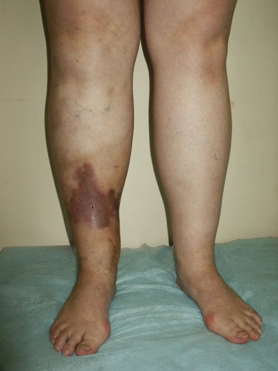 Венозная недостаточность ног: ретикулярный варикоз