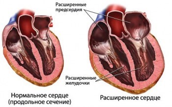 Как отличить боль в сердце?