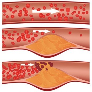 Холестериновые бляшки в сосудах, артериях: лечение, чем опасны