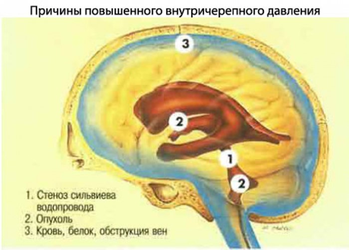 Болезни сосудов головного мозга
