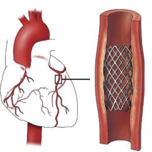Процесс реабилитации после инфаркта миокарда и проведения стентирования