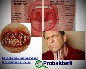 Инфекции горла, их виды, симптомы и лечение