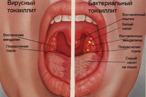 Инфекции горла, их виды, симптомы и лечение