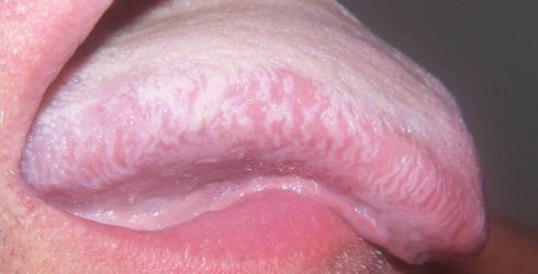 Почему возникает белый налет в горле: выясняем причину