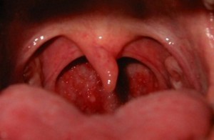 Боль в горле после ангины
