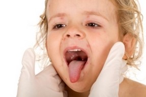 Причины и лечение боли в горле у ребенка