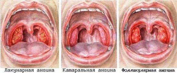 Грибковые заболевания горла