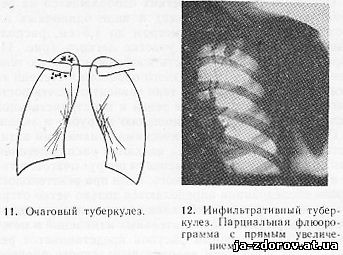 Определение туберкулеза легких на флюорографии