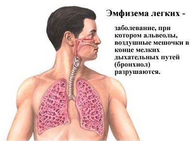 Эмфизема как осложнение астмы