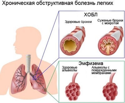 Эмфизема как осложнение астмы