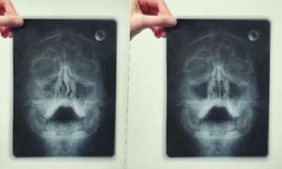 Как выглядит гайморит на рентгеновском снимке?