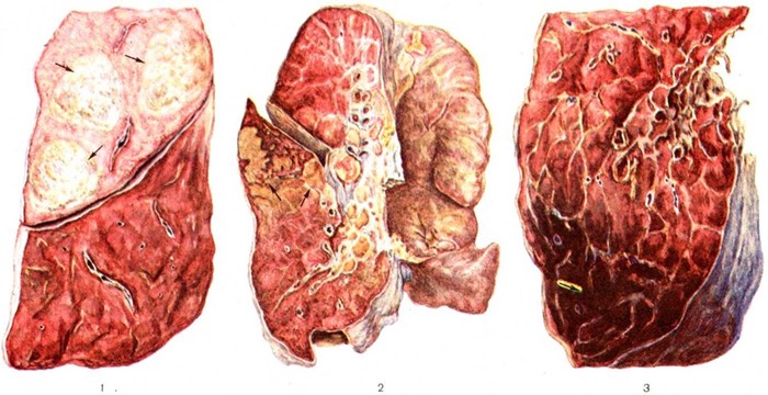 Геморрагическая пневмония: причины, особенности, лечение